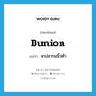 bunion แปลว่า?, คำศัพท์ภาษาอังกฤษ bunion แปลว่า ตาปลาบนนิ้วเท้า ประเภท N หมวด N